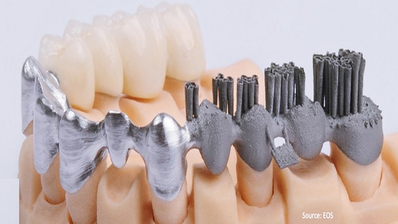 Indian Researchers Evaluate Traditional Metal Manufacturing Methods Against 3D Printing For Dental Copings