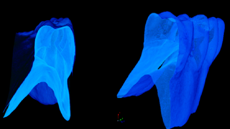 3D Printed Dentures Made With Hybrid Nanocomposite Yield Excellent Results