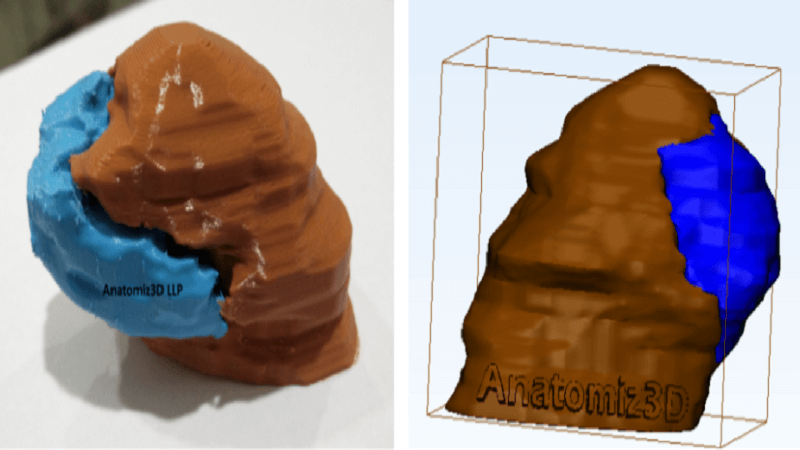 3D Printing cures Tongue Cancer via Anatomiz3D
