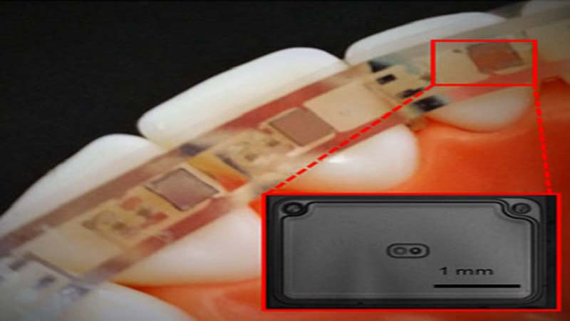 Braces 3D Printed Infrared