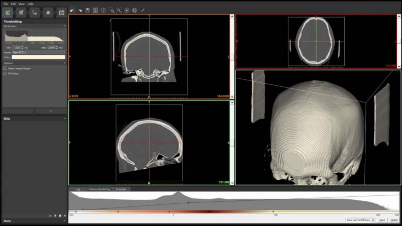 Mimics inPrint Software by Materialise and Siemens rolls to Hospitals Worldwide