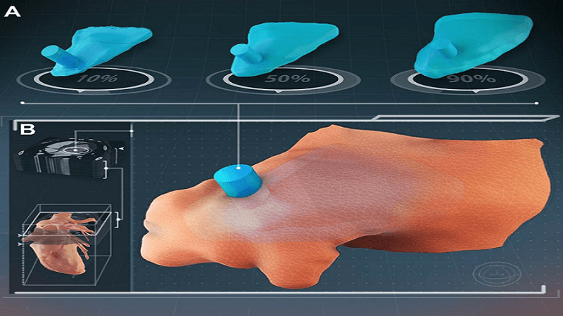 Patients With High Risk of Atrial Fibrillation to Benefit From 3D Printed Occluder Device