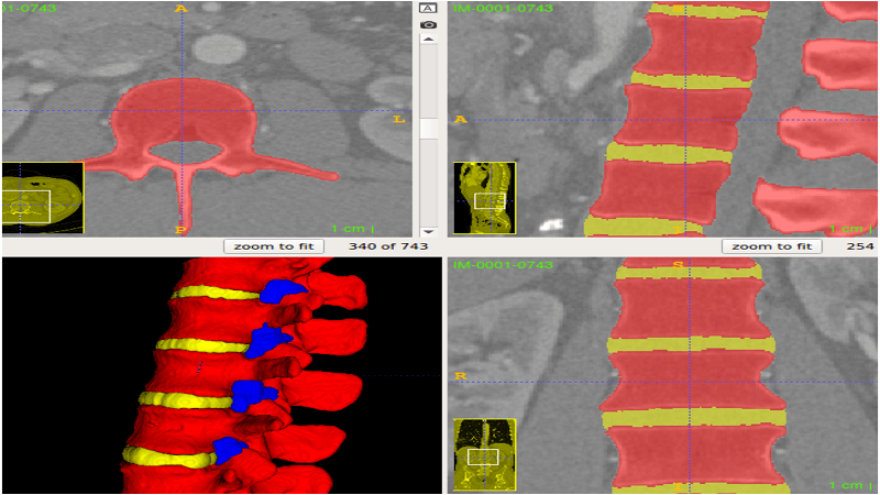 Neuraxial Anesthesia Training Phantom Gets 3D Printed For Just 13