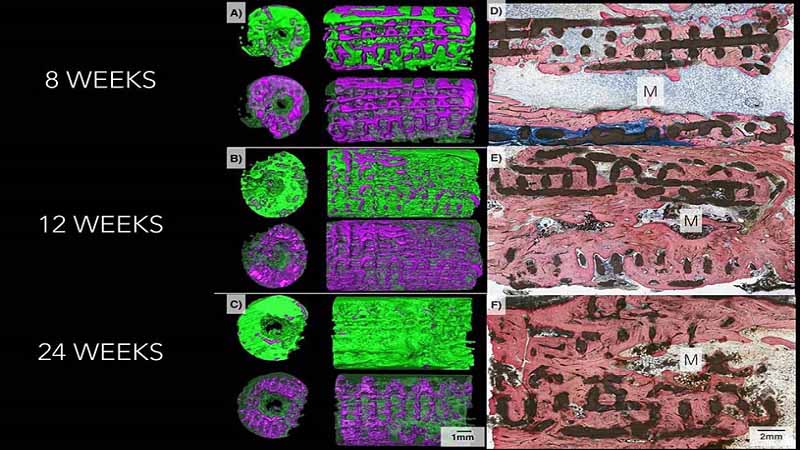 Bone Defects To Be Restored Through 3D Printed Ceramic Implants