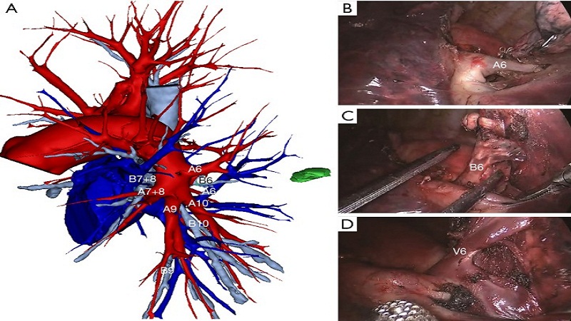 3D Printing Shows Promises In Pre Operative Planning For Lung Cancer Surgeries