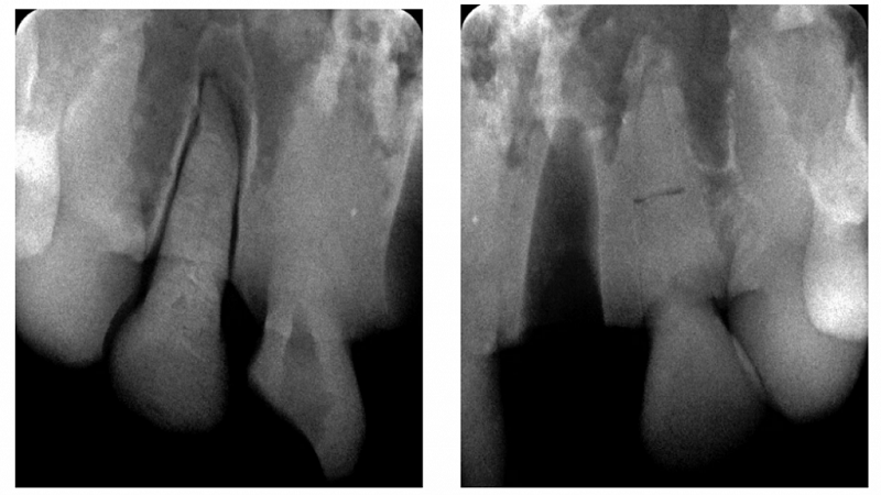 3D Printed Models For Dental Traumatology Offer Better Training Case Scenarios