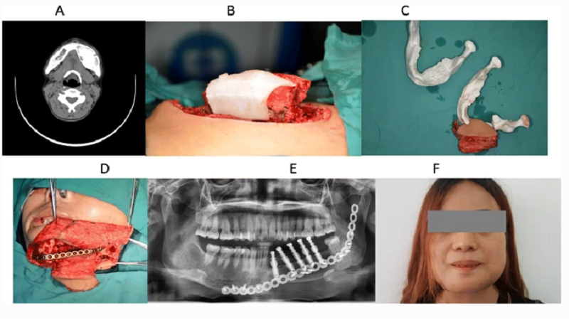 3D Printing Assisted With Virtual Reality Excels In Field Of Head Neck Tumour Surgeries