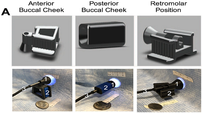 3D Printing Makes Applicators With PDT For Oral Cancer Treatment Effective And Cheaper