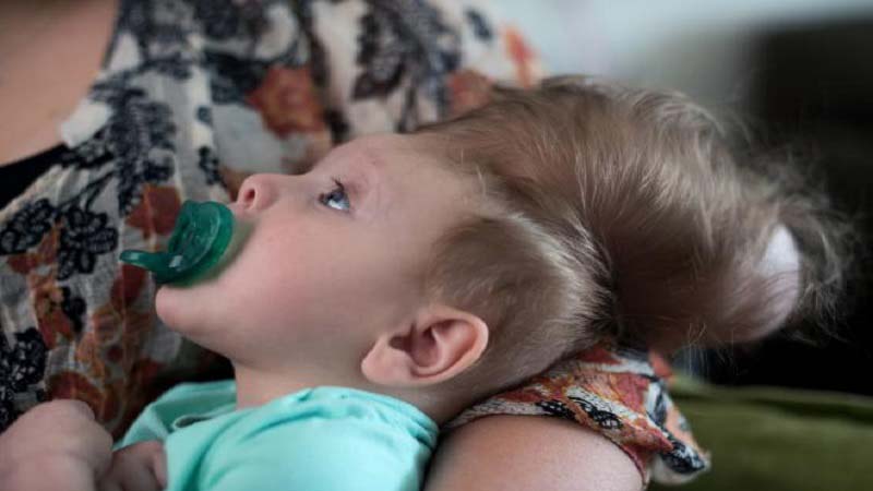 Bentley Yoder gets treatment for Encephalocele by 3D Print