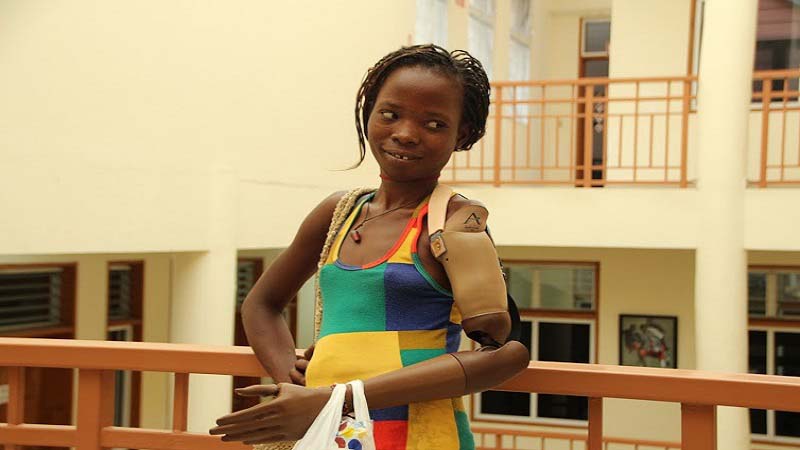 Create Prosthetics deliver First Medical Grade 3D Printed Arm to Earthquake Survivor