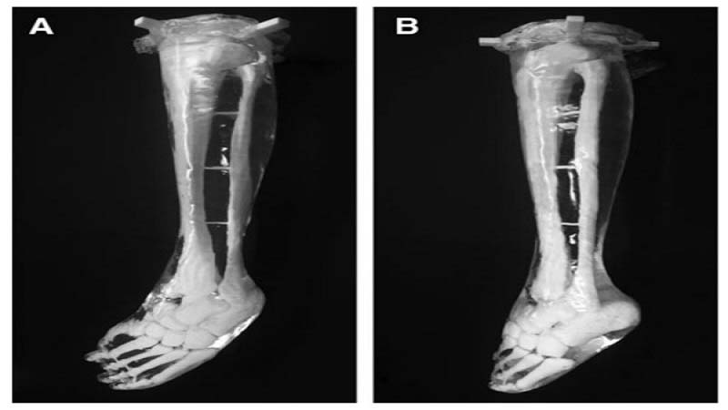 Researchers use Medical Phantom Model for Clubfoot Treatment