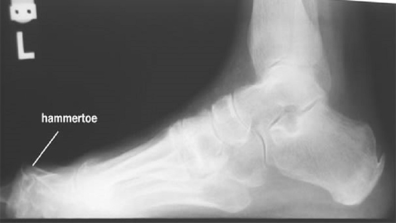 HAMMERTOES TREATMENT WITH 3D PRINTED IMPLANTS BY ADDITIVIE ORTHOPAEDICS