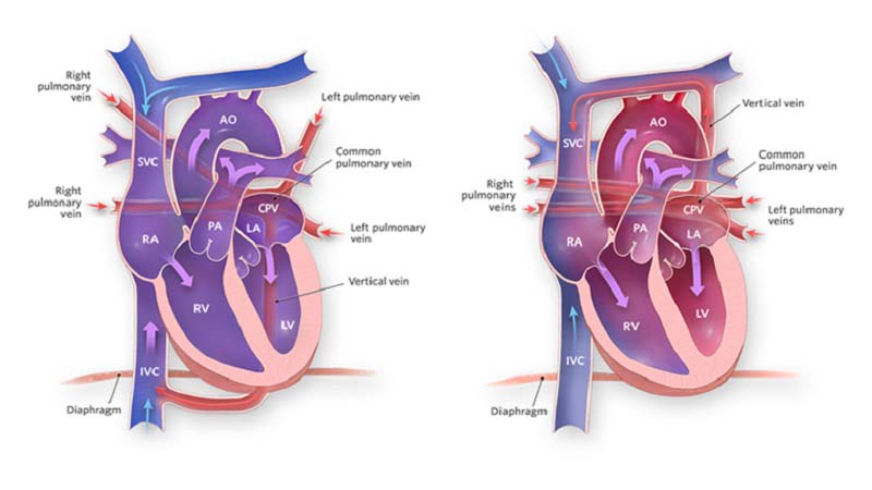 3d print 9 month baby heart defect