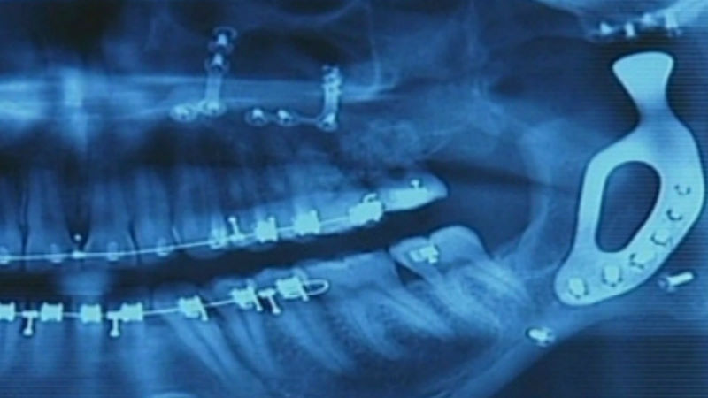 jaw implant 800x450